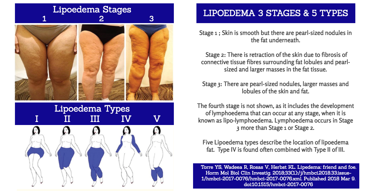 Lipedema Surgery: Three Weeks Post-Op