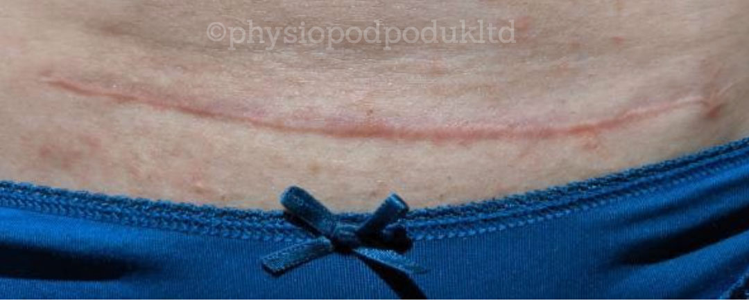 Photograph of the left corner of the cesarean section scar showing